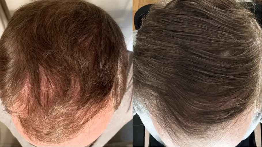 A side-by-side comparison showing thinning hair on the left and thicker, darker hair on the right.