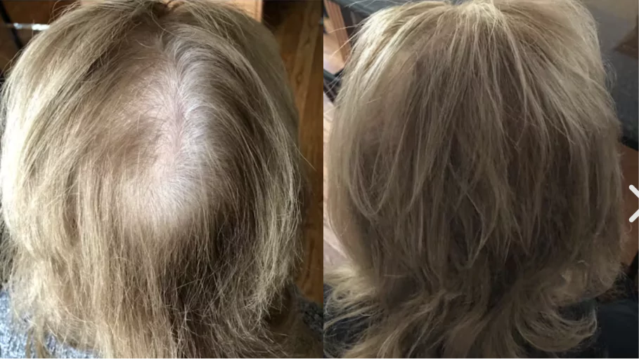 Comparison of hair with visible scalp and fuller hair without visible scalp.