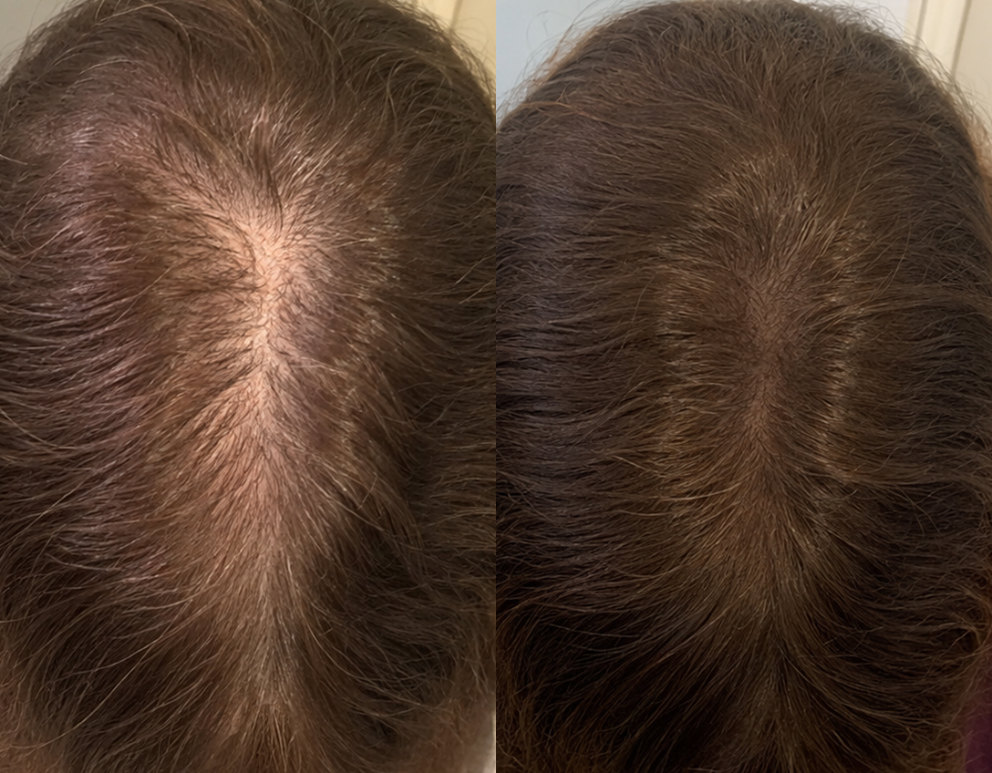 A before-and-after comparison of the top of a head, showing thinner hair on the left and fuller hair on the right.