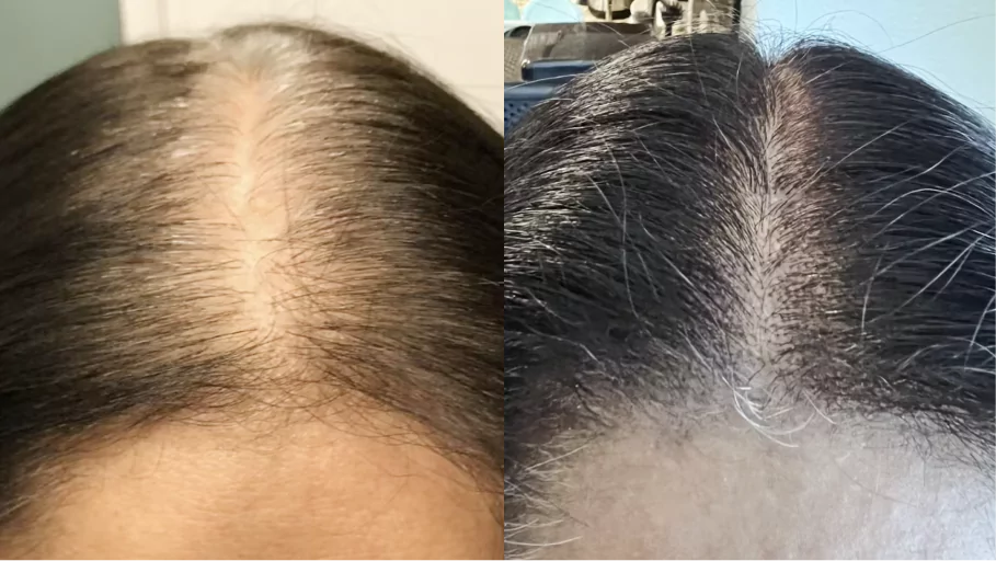 Two close-up images showing changes in gray hair coverage on a person's scalp.