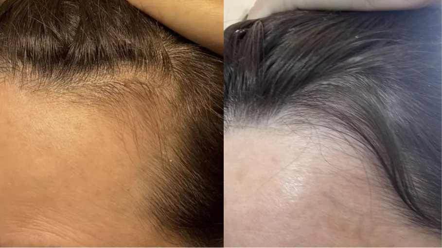 Two images comparing the top view of an older person's head with grey hair.