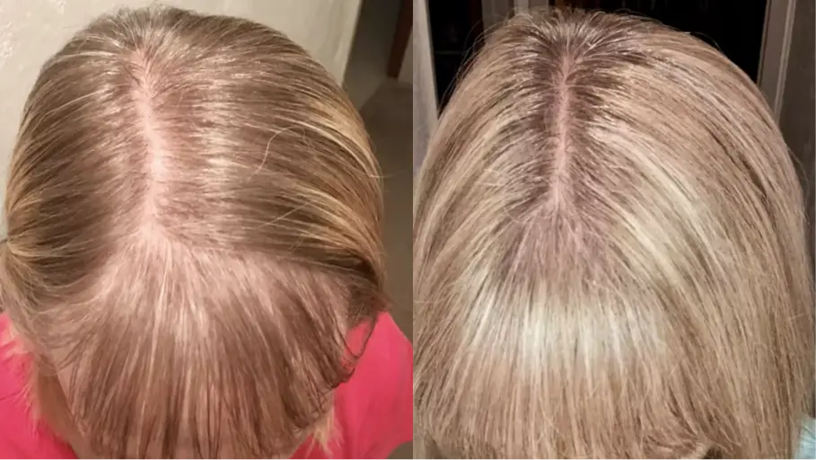 A before-and-after comparison of a woman's scalp, showing an increase in blonde hair fullness and coverage.