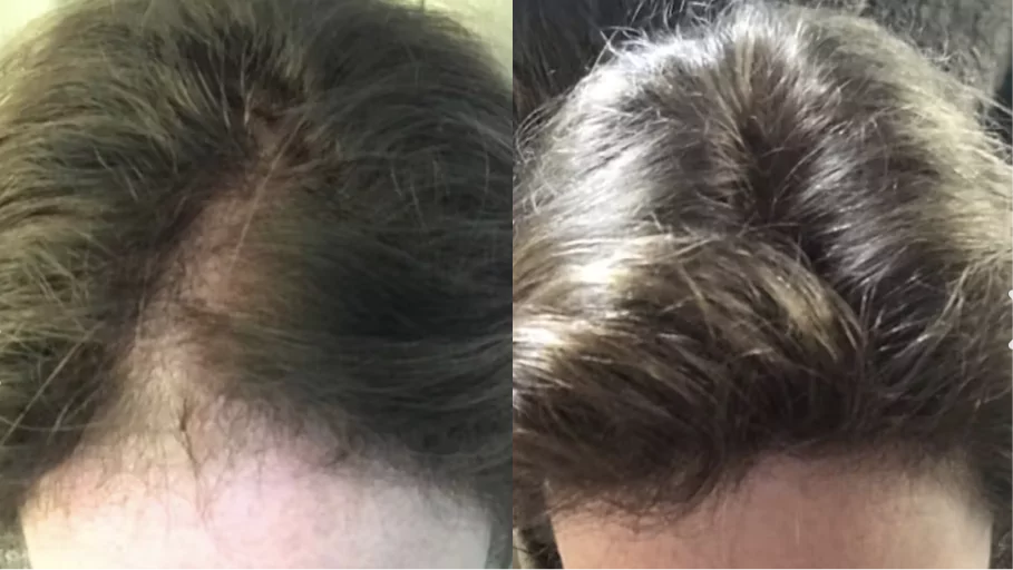 Close-up of a person's scalp and hair from the top view.