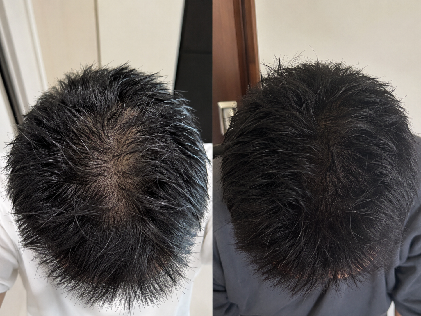 A split image showing a before-and-after comparison of hair density on the crown of a person's head.