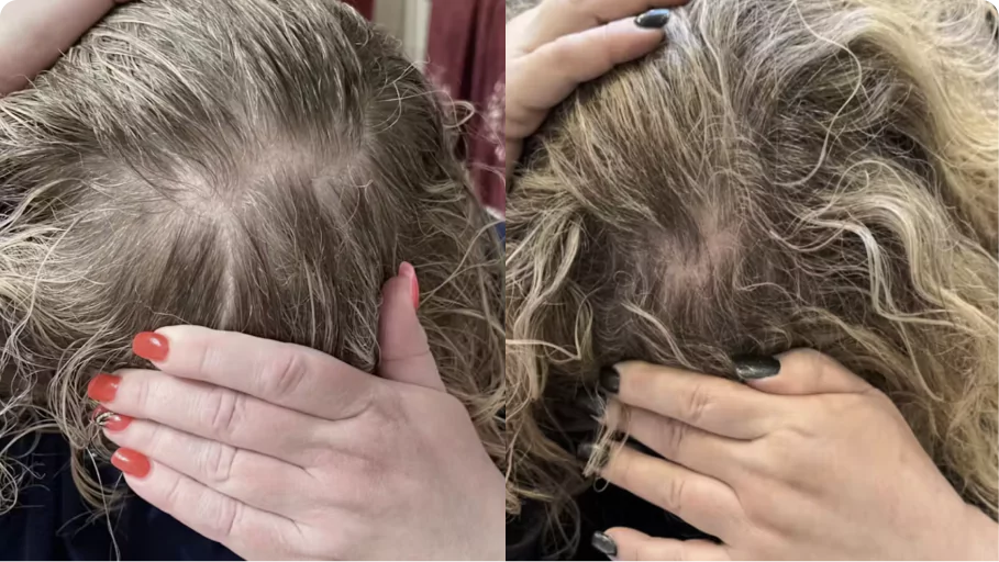 Side-by-side comparison of different hairlines in close-up view.