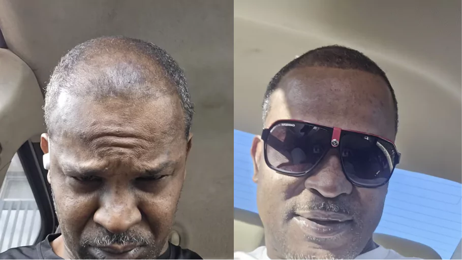 Side-by-side comparison of two close-up views of hairline and scalp.