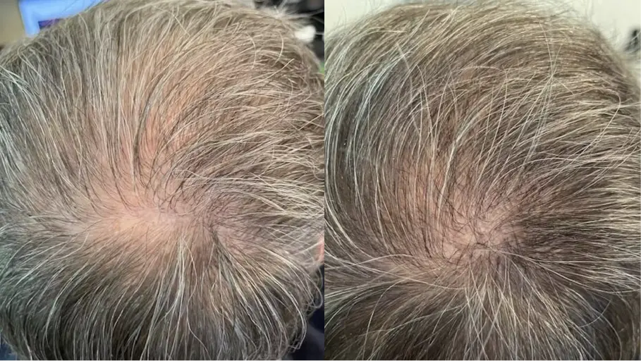 Comparison of a bald scalp and a hair-covered scalp.