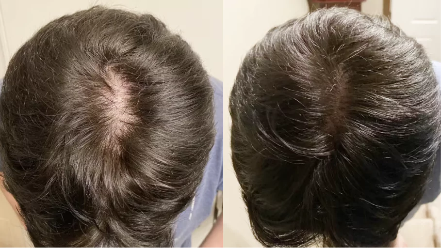 Comparison of hair thinning on two scalps from different angles.
