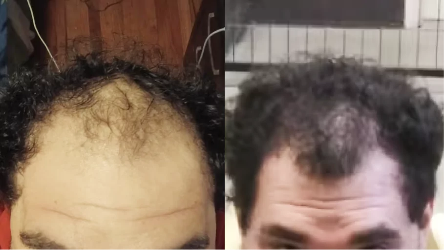 Side-by-side comparison of a person's scalp, showing thinning hair and fuller hair.