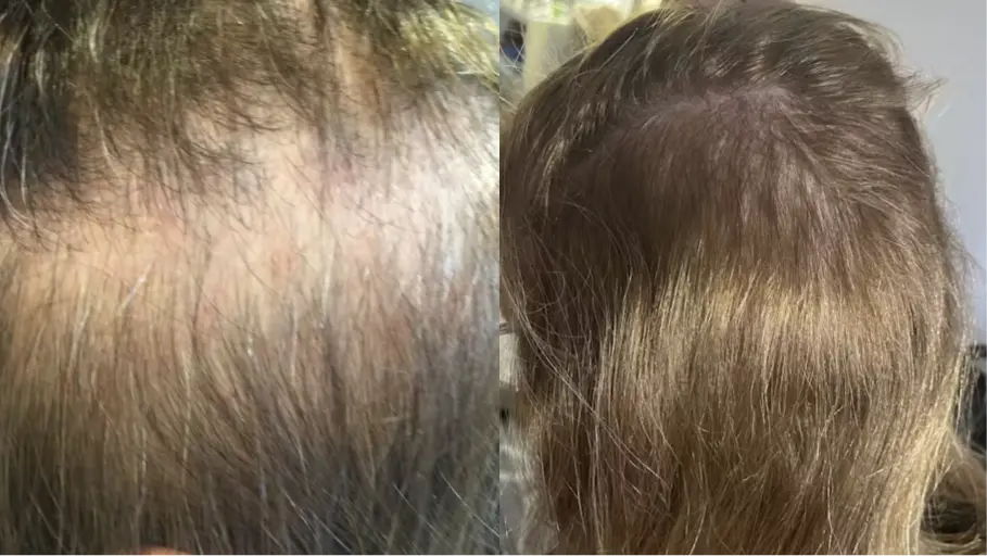 Two photos showing the top of a person's head with thinning hair.